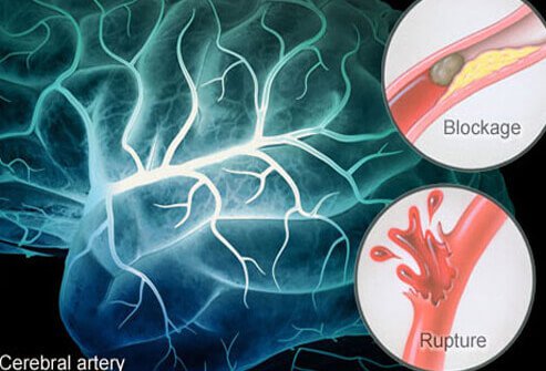 Stroke Causes, Symptoms, and Recovery      Reviewed By: William C. Shiel Jr., MD, FACP, FACR